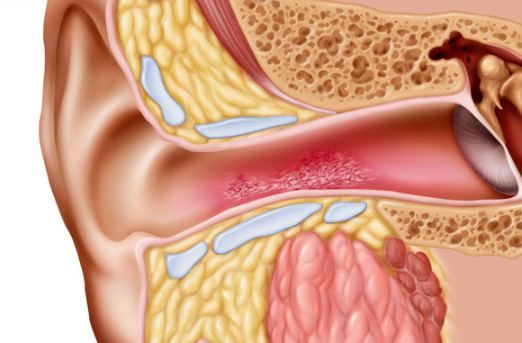 Get Online Treatment for Swimmer’s ear in Turkey from a | Online Doctor & Online Prescription | E-rx.online